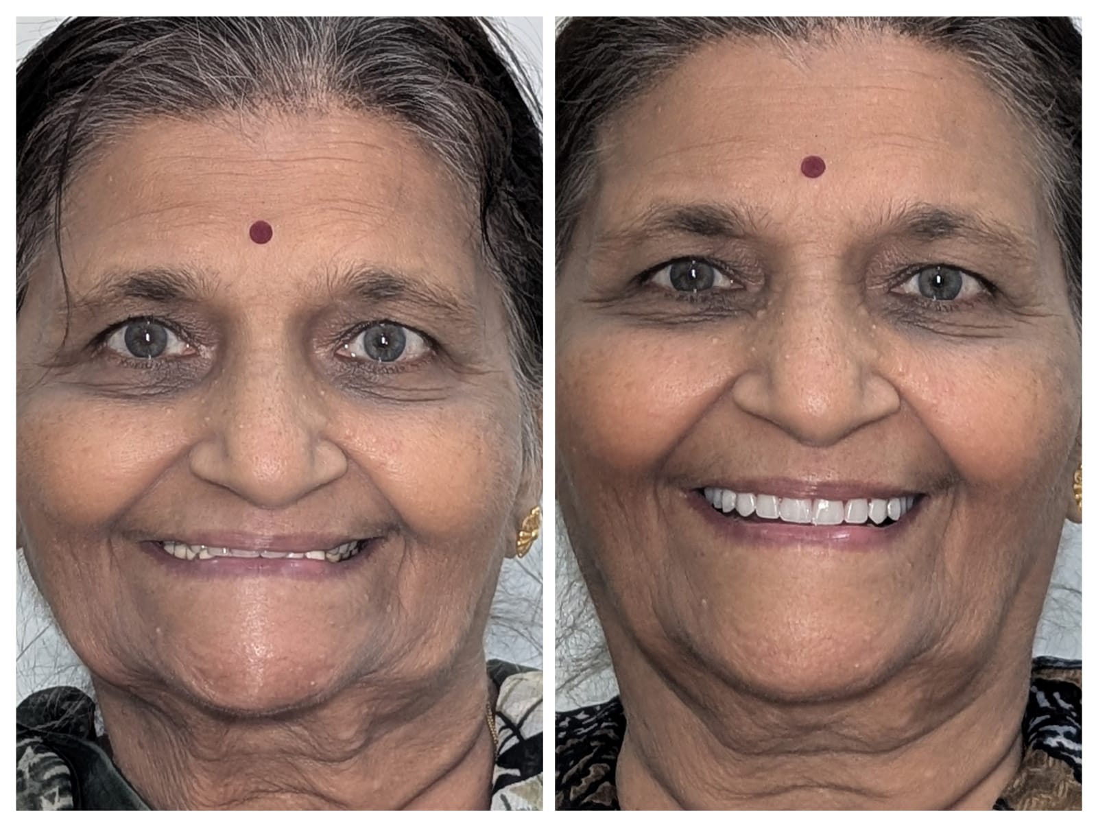 Full mouth implant rehabilitation before and after — Millennium Smile Dental Clinic, Andheri West Mumbai