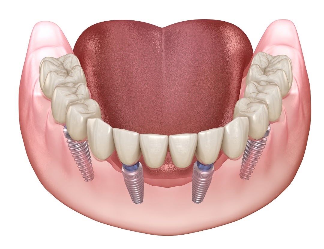 All-on-4 implant-supported bridge diagram