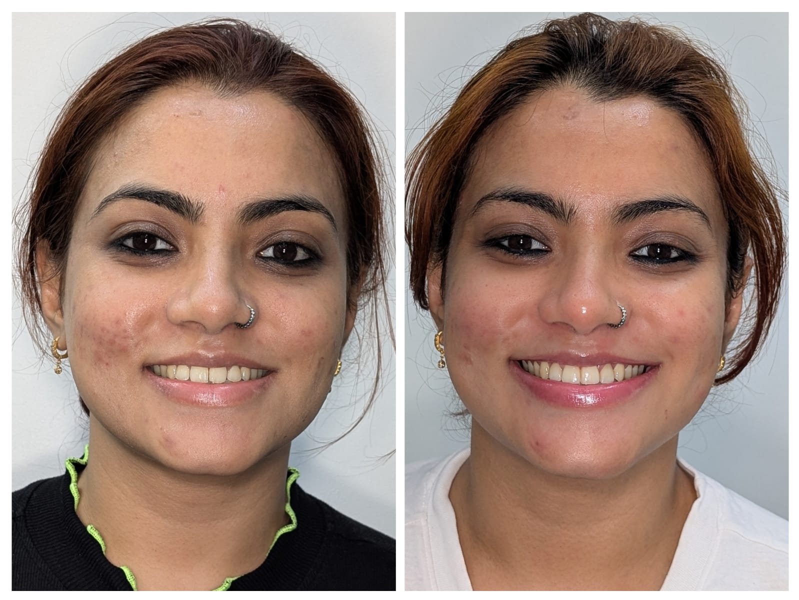 Crowding & Bite Correction with Aligners before and after dental treatment result at Millennium Smile Dental Clinic, Andheri West, Mumbai