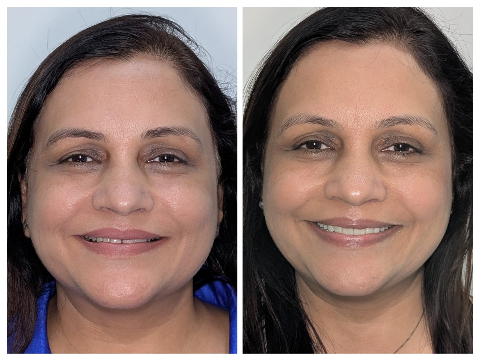Full Mouth Rehabilitation with Crowns before and after dental treatment result at Millennium Smile Dental Clinic, Andheri West, Mumbai