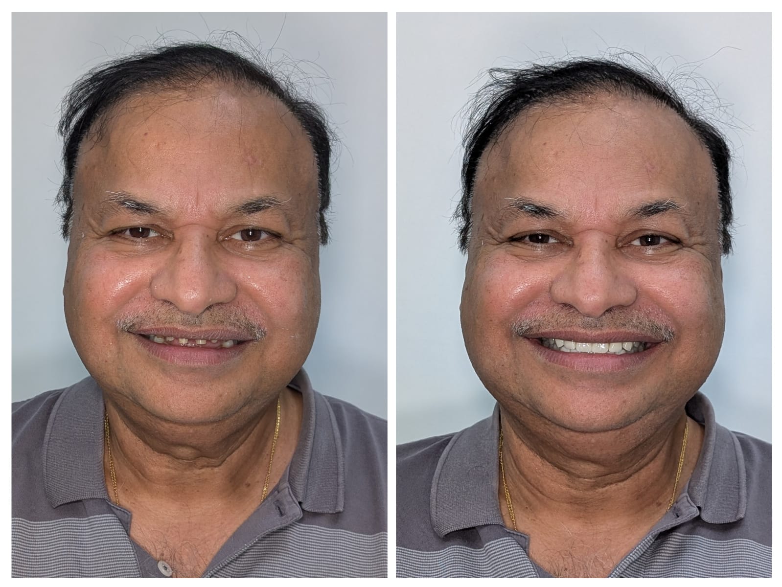 Full Smile Restoration, before and after result at Millennium Smile Dental Clinic