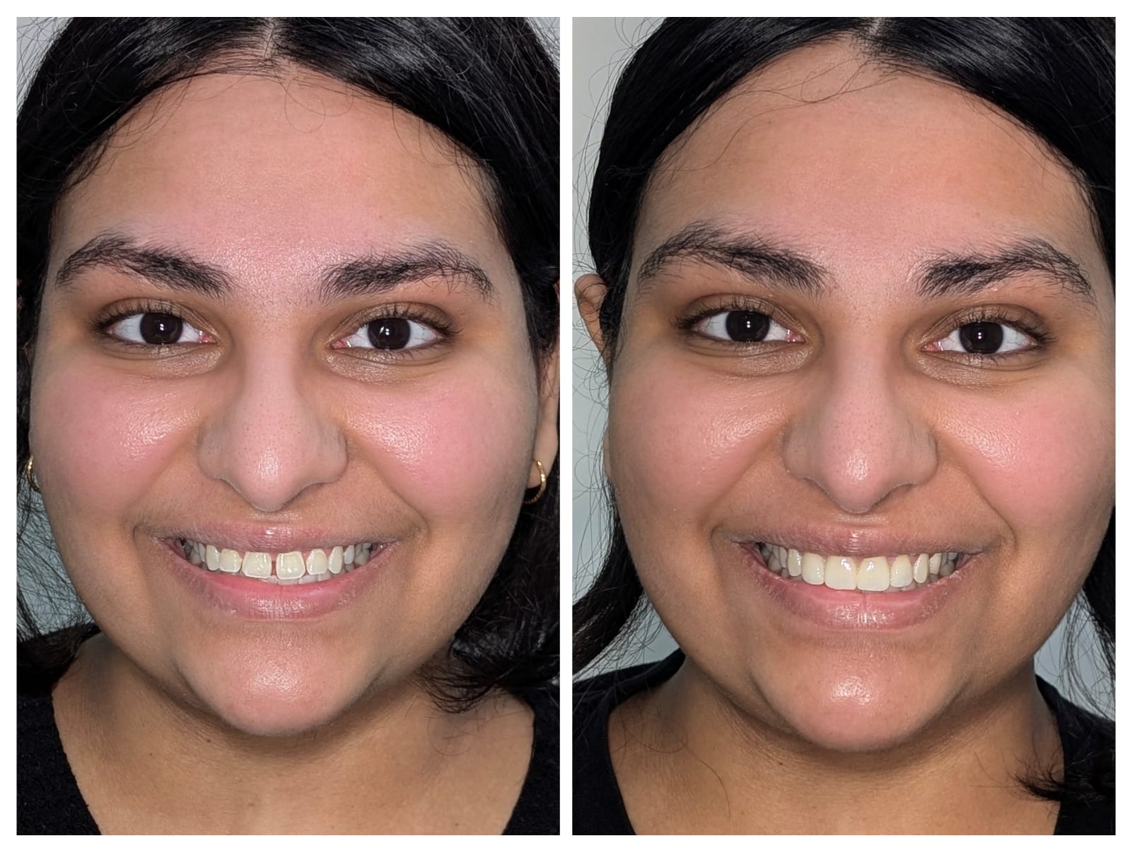 Invisible Aligners, before and after result at Millennium Smile Dental Clinic