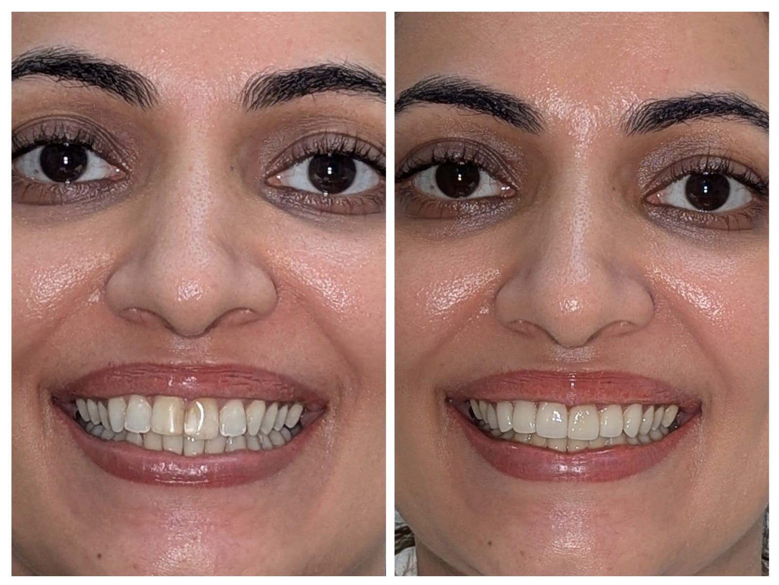 Porcelain Veneers, before and after result at Millennium Smile Dental Clinic