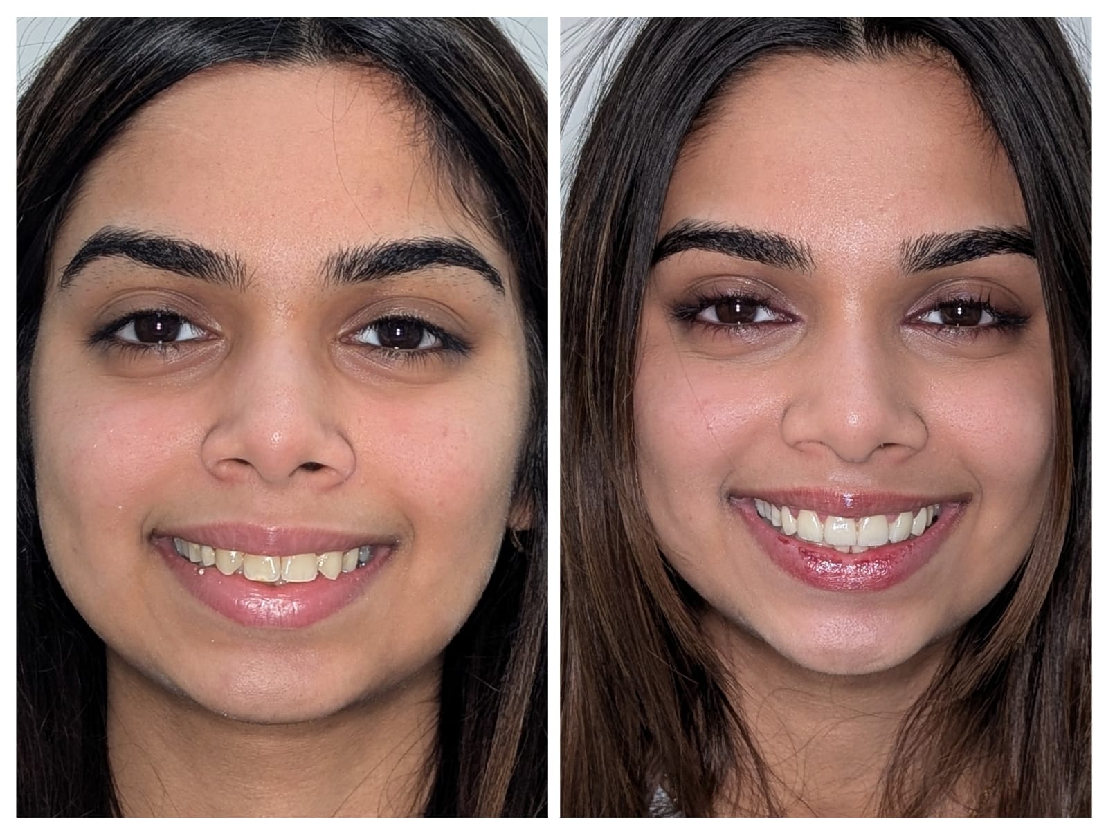 Smile Makeover, before and after result at Millennium Smile Dental Clinic